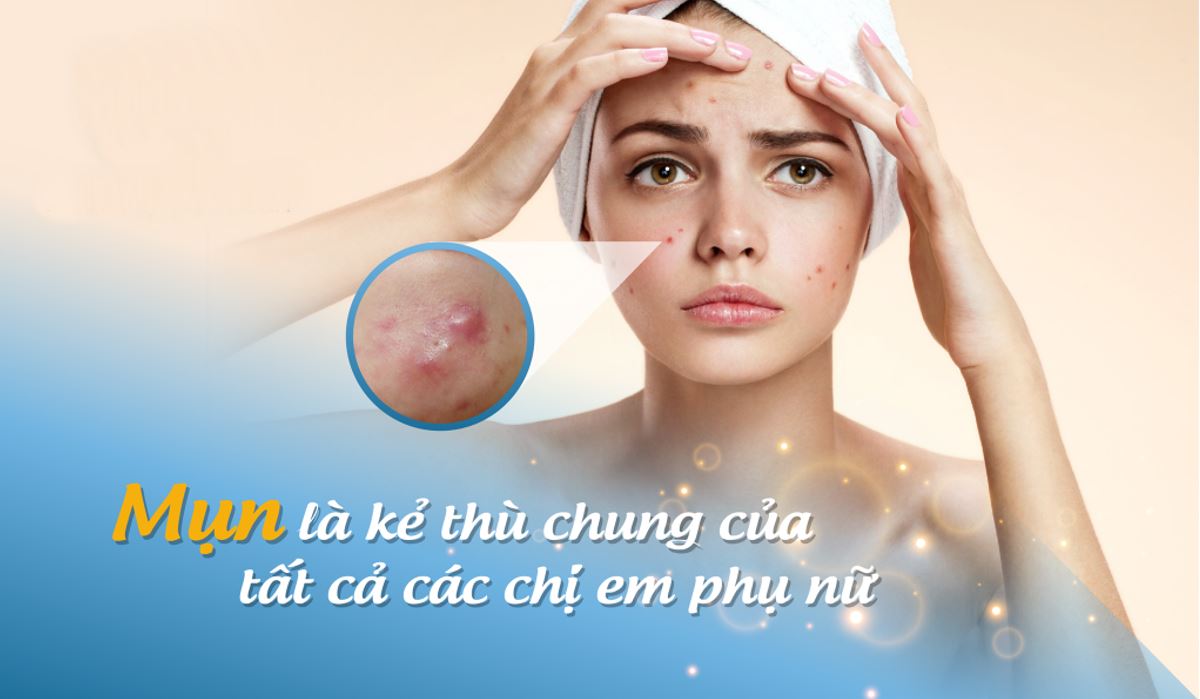 Những nguyên nhân hàng đầu gây ra mụn 1